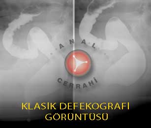 Baryum Defekografi görüntü