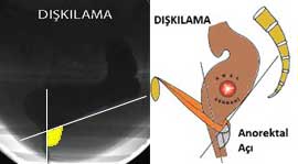 defekografi ıkınma