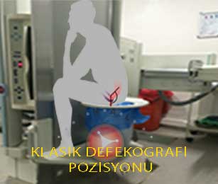 Defekografi pozisyonu